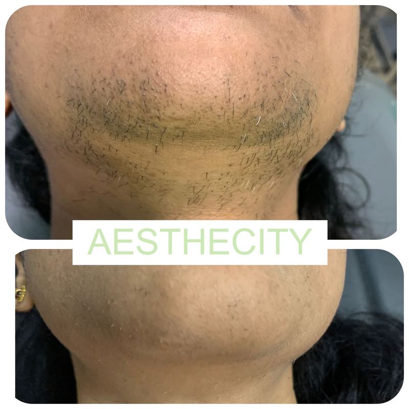 Laser hair reduction before and after