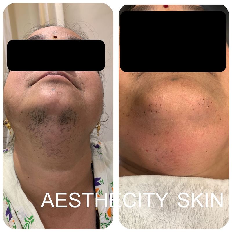 Laser hair reduction before and after