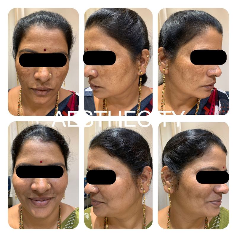 Pigmentation and melasma treatment results