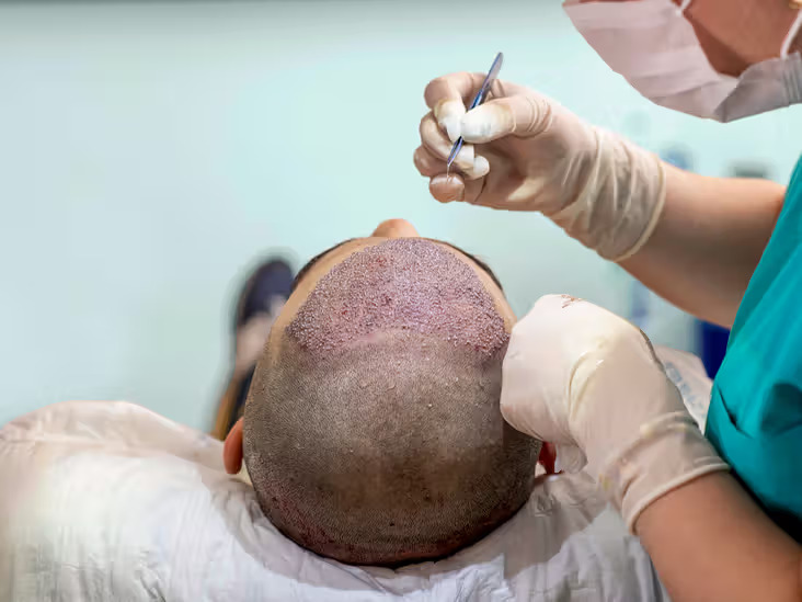 hair transplant treatment in PCMC, Pune